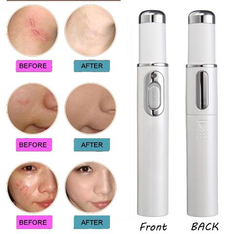 [#3] Portable Blue Light Therapy Acne Laser Pen(for every skins); 1*AAA batery needed